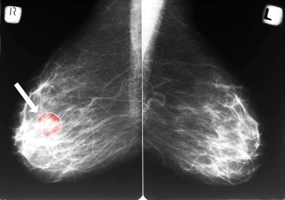 {It Happened to Me} I Have Breast Cancer